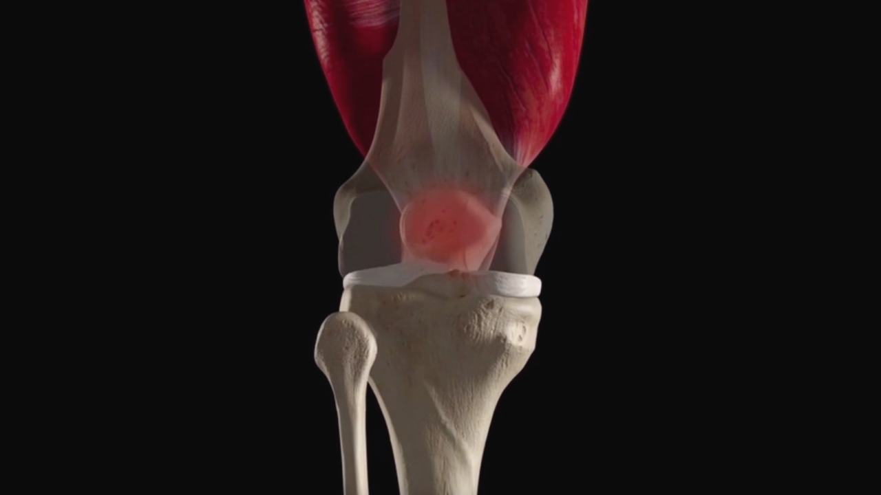 Syndrome fémoropatellaire, comment le traiter? Nxt Generation PHYSIO