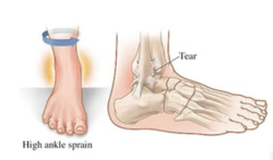 High ankle sprain