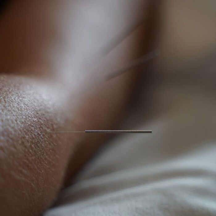 Acupuncture