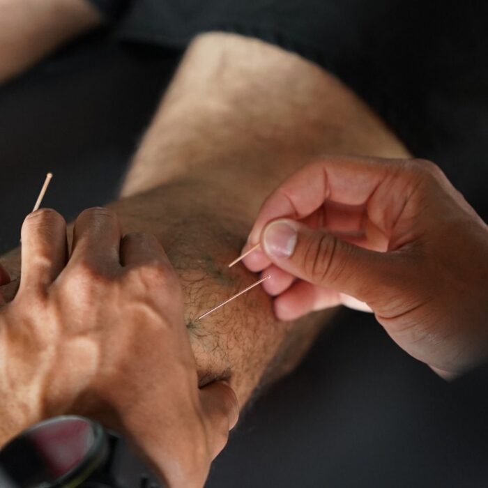 Acupuncture